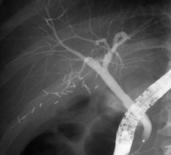 Pancreatic-and-Biliary-Disorders Pancreatic-and-Biliary-Disorders