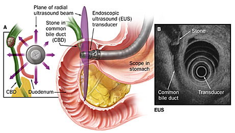 Endoscopic Ultrasonography Endoscopic Ultrasonography