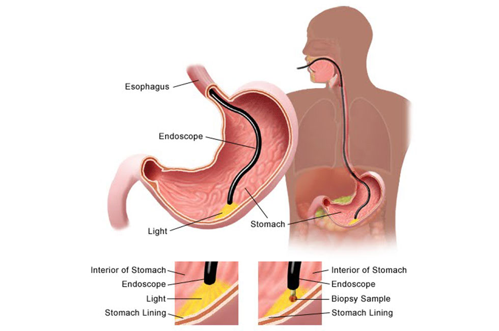 Gastroscopy-page Gastroscopy-page
